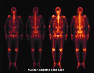 Nuclear Medicine Scan